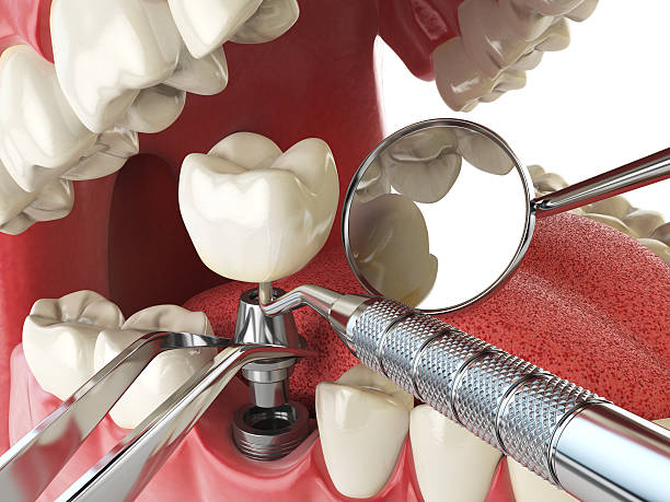 Best Emergency Root Canal Treatment in White Oak, TX